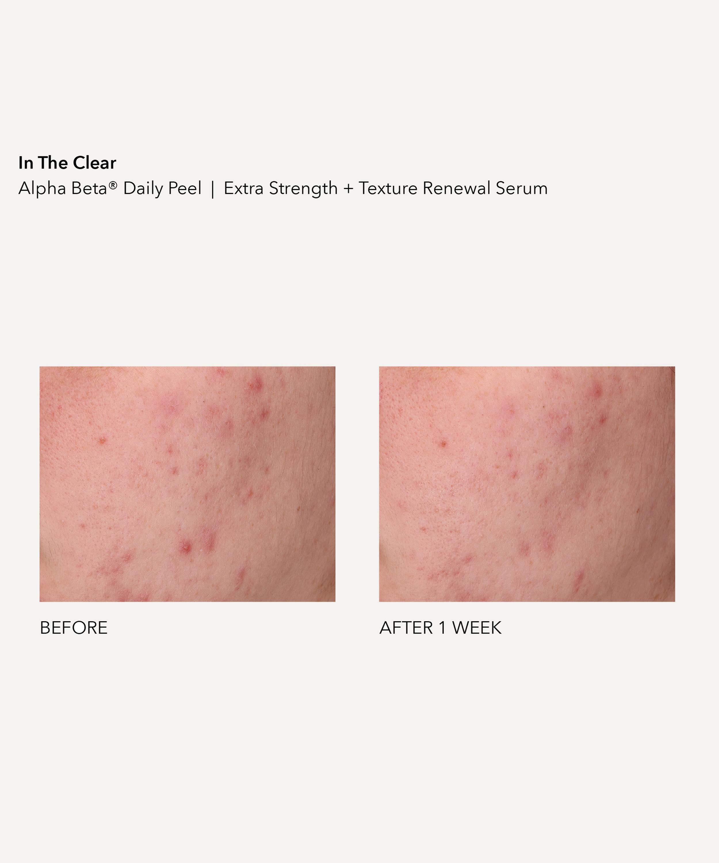 Dr. Dennis Gross Skincare - In the Clear Kit image number 3