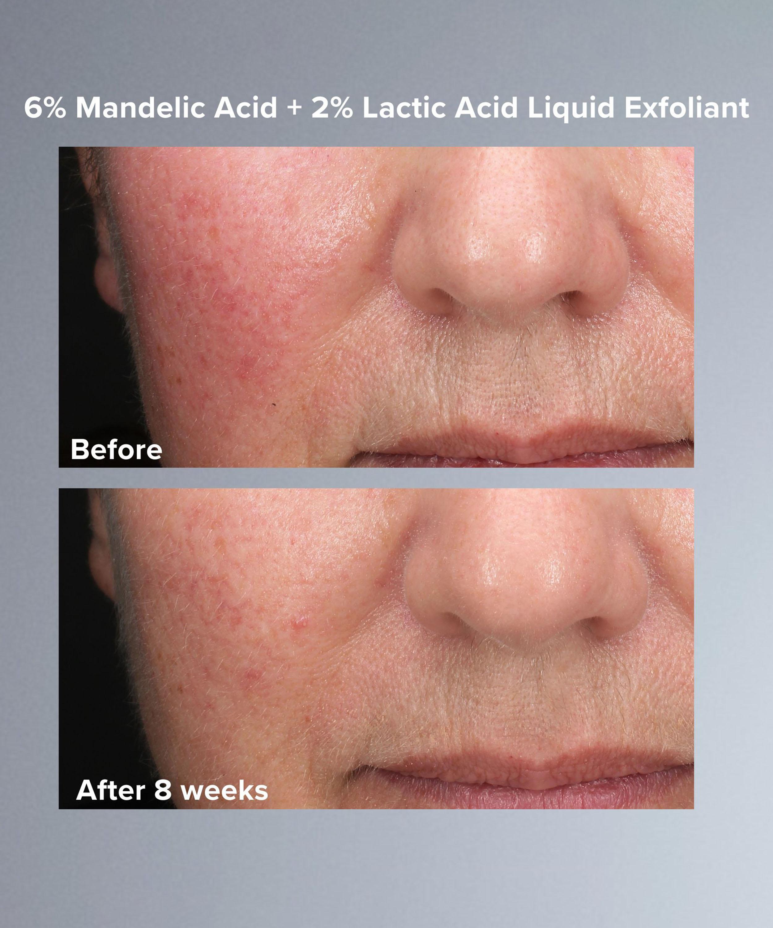 Paula's Choice - Mandelic and Lactic Acid AHA Liquid Exfoliant 30ml image number 5