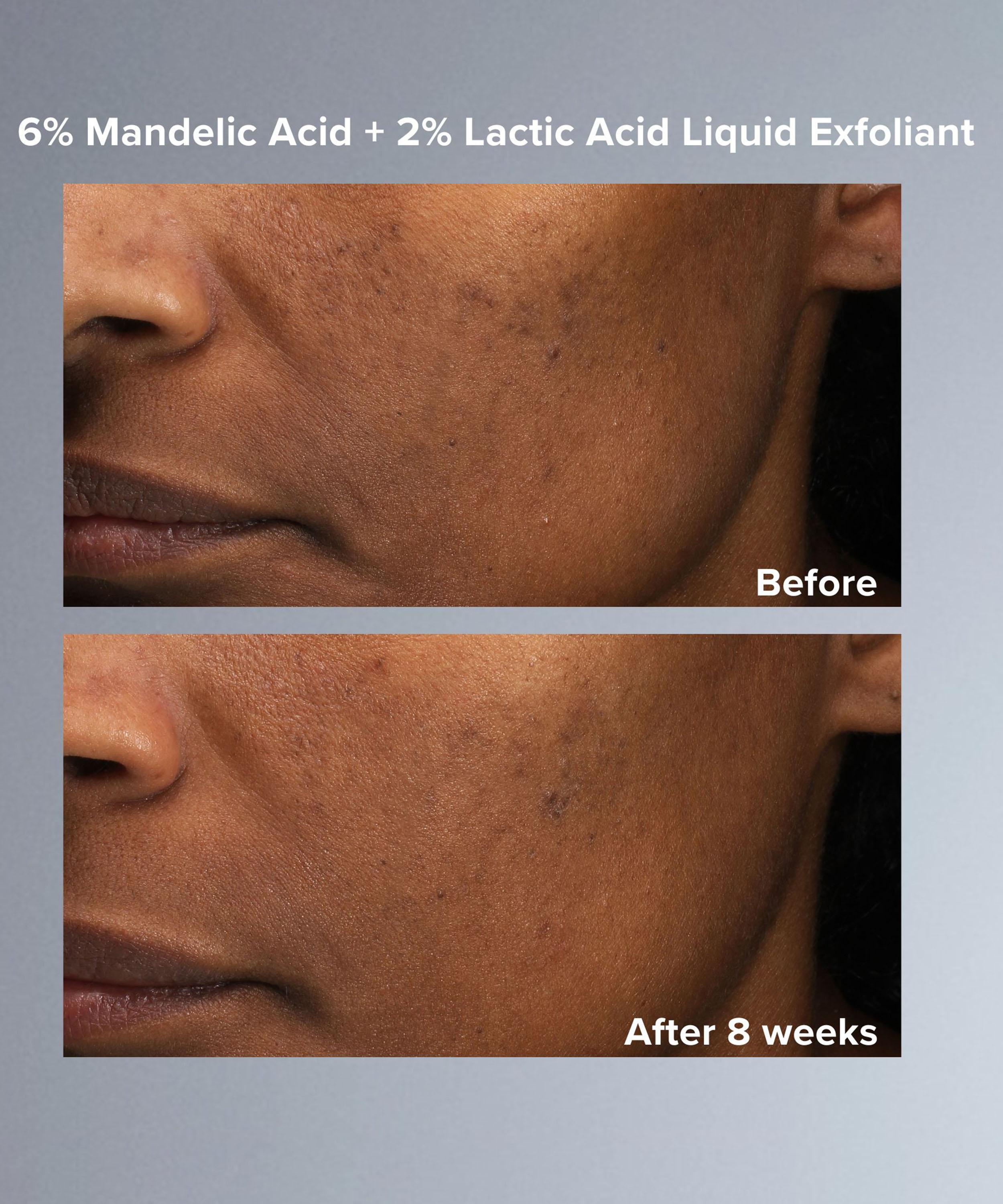 Paula's Choice - Mandelic and Lactic Acid AHA Liquid Exfoliant 30ml image number 7