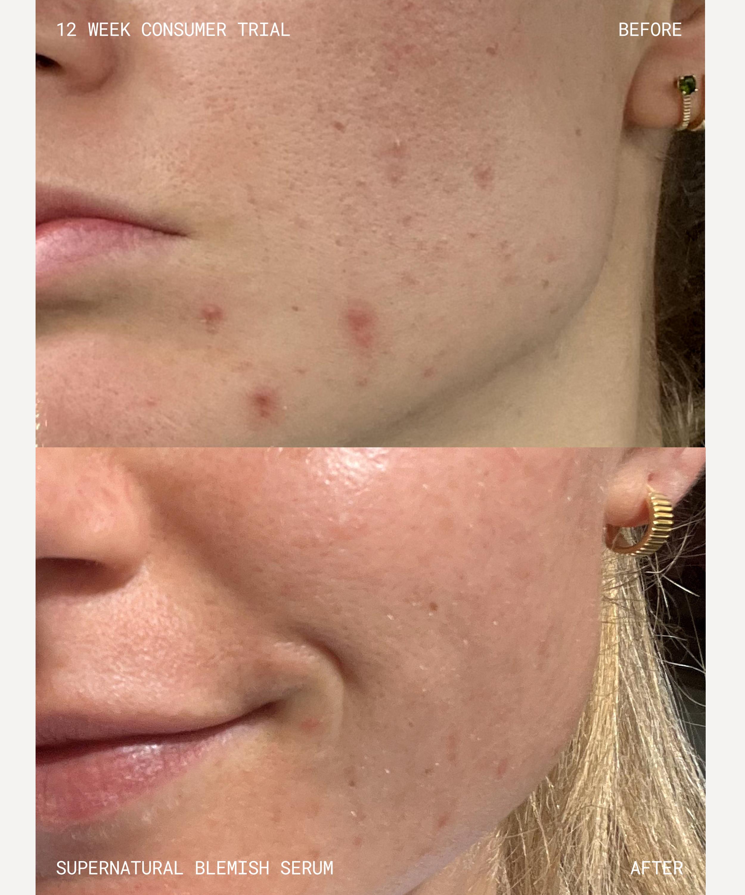 Emma Lewisham - Supernatural Blemish Serum 60ml image number 6