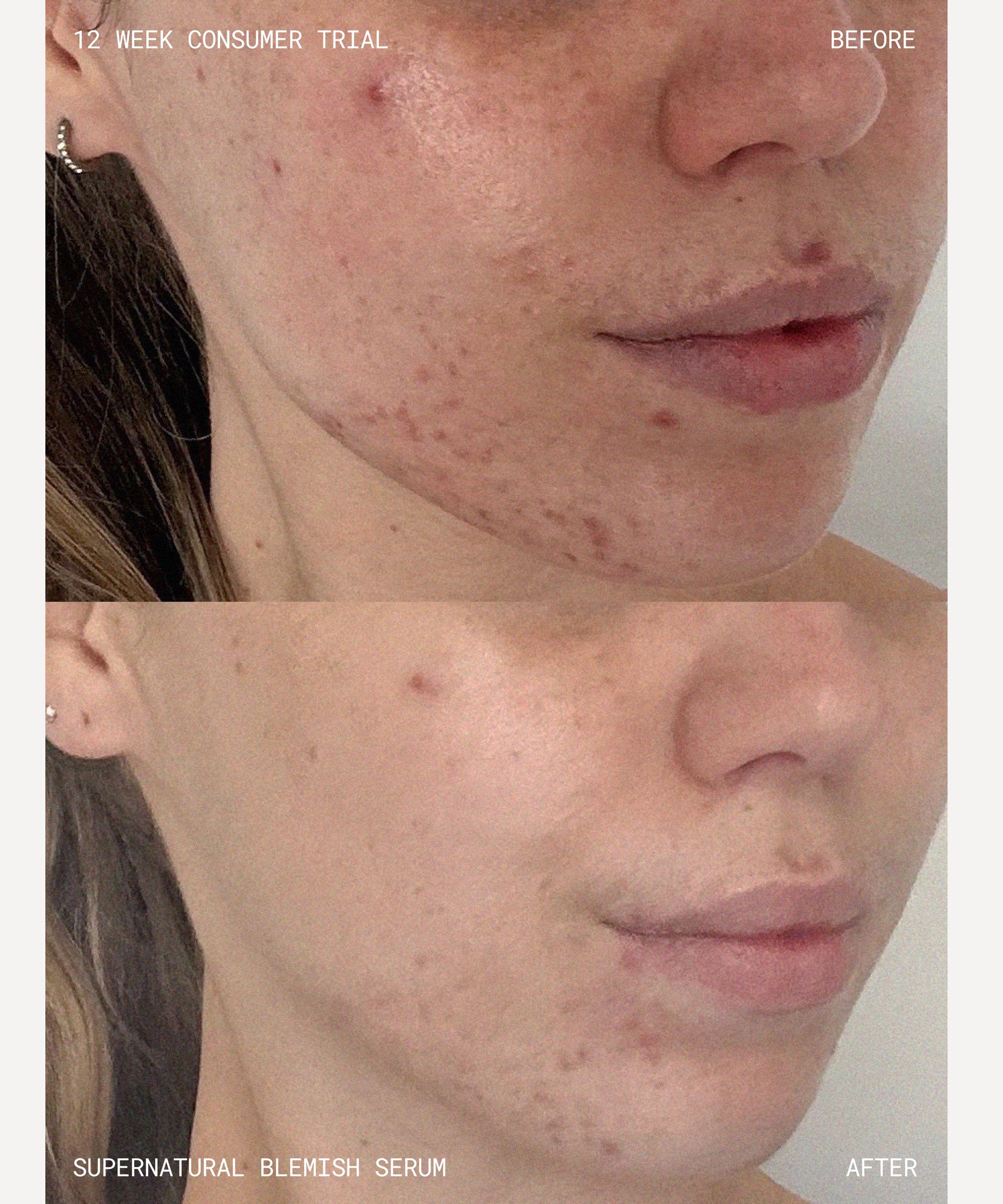 Emma Lewisham - Supernatural Blemish Serum 60ml image number 7