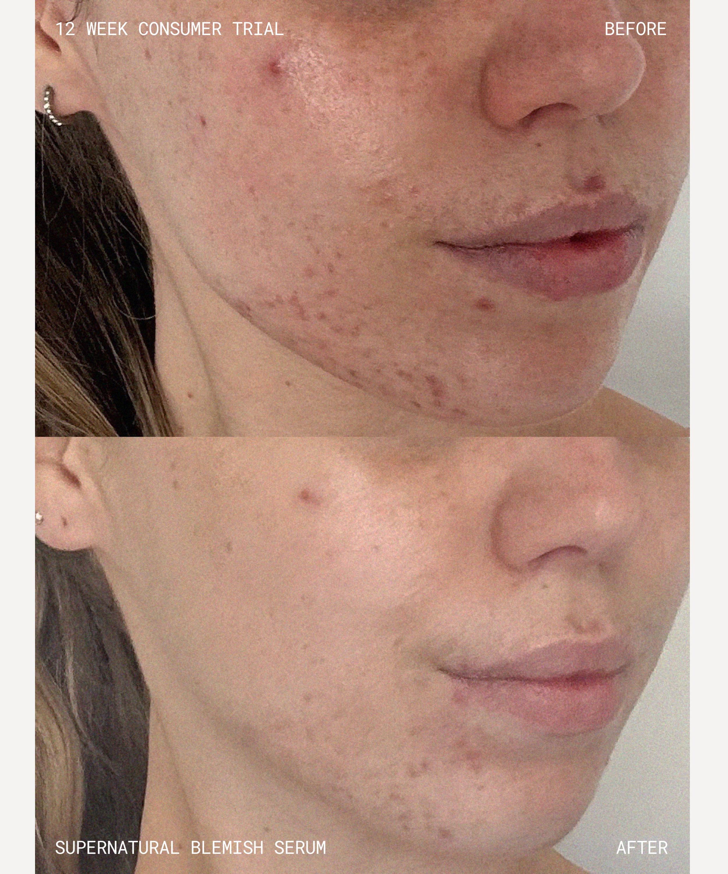 Emma Lewisham - Supernatural Blemish Serum Refill 60ml image number 7