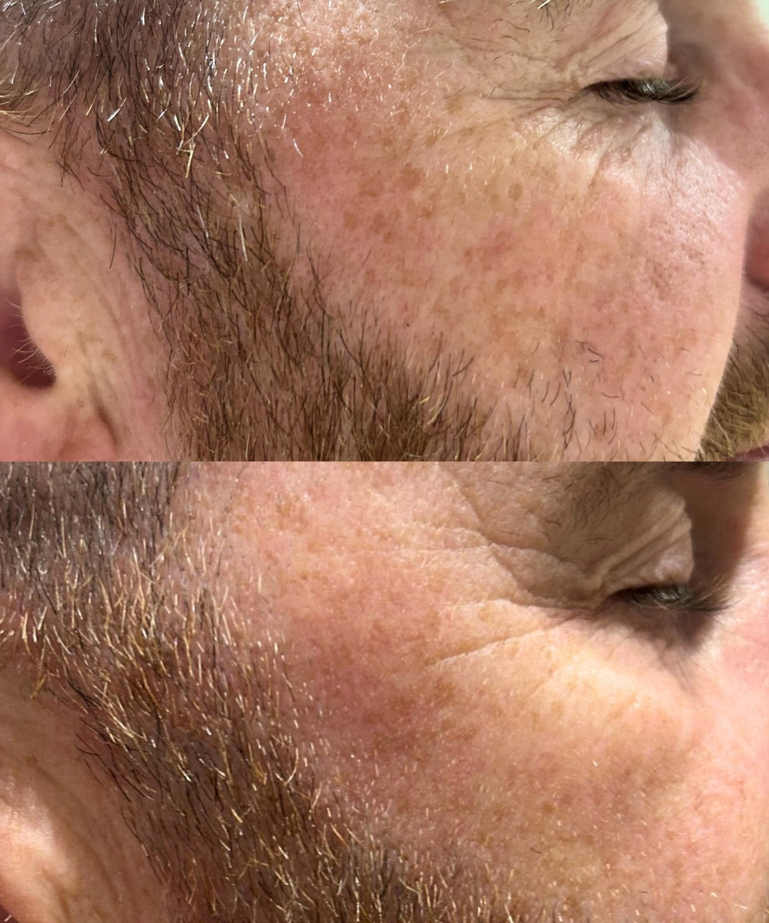 Dr. David Jack - Yellow Peel Pigment Correcting Mask Refill image number 4