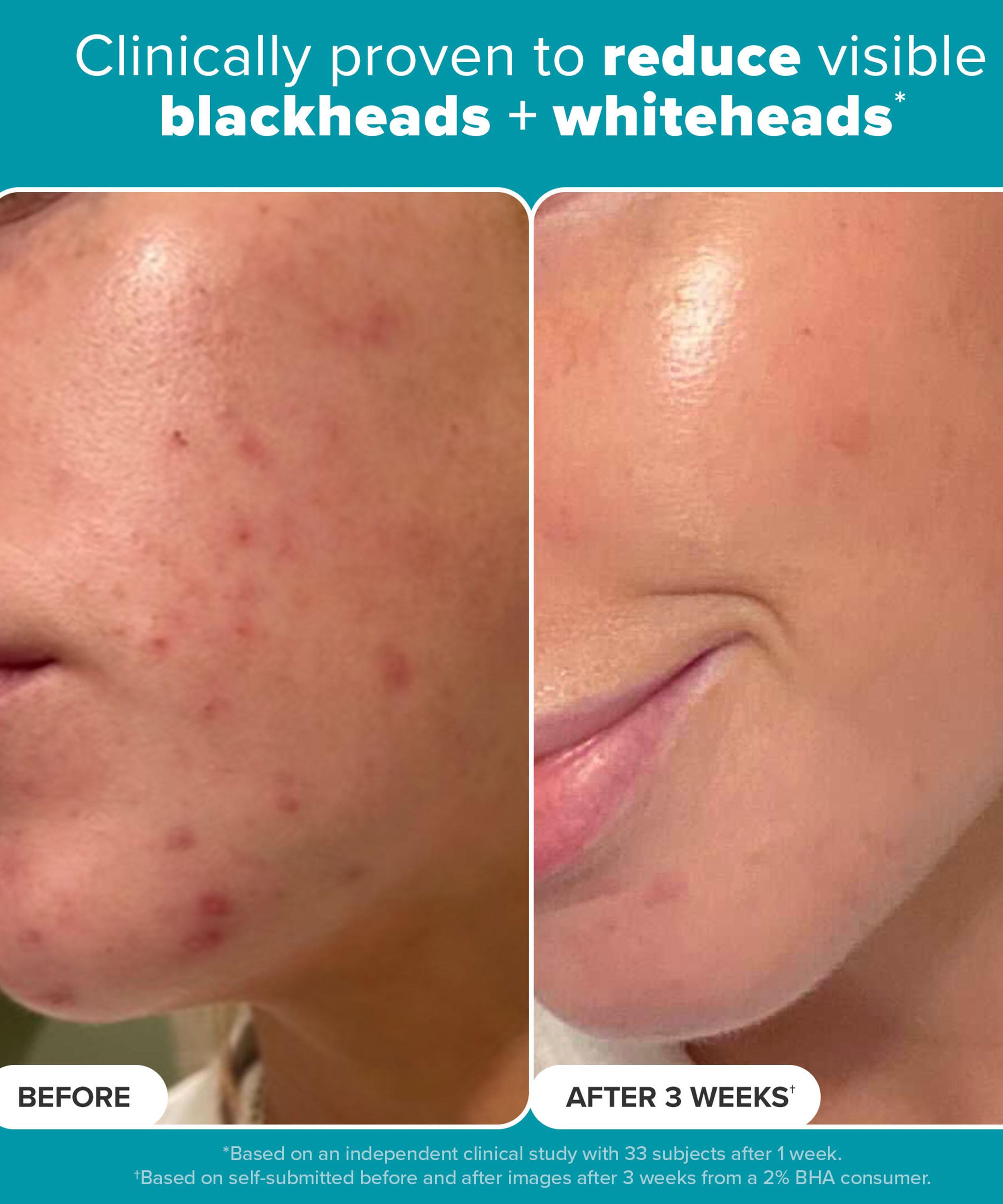 Paula's Choice - Skin Perfecting 2% BHA Exfoliating Pads image number 2
