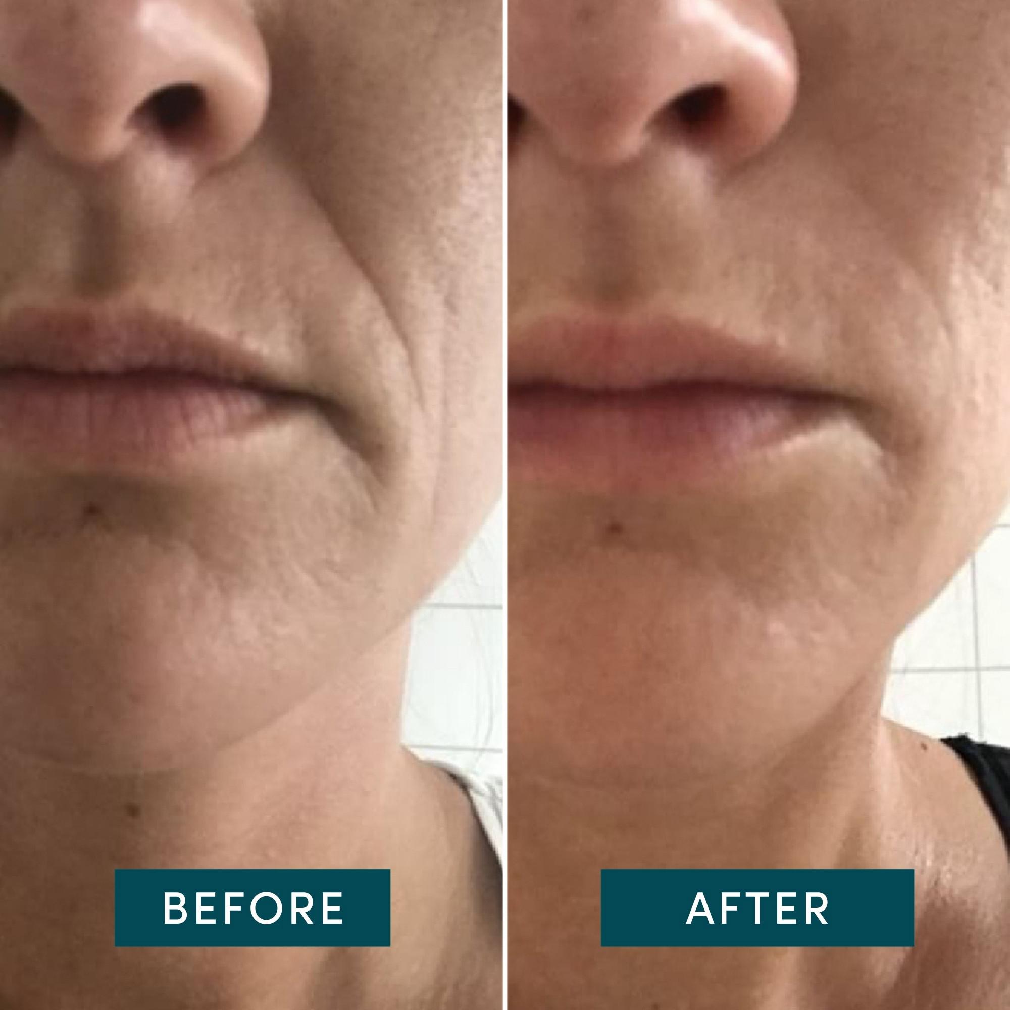 APRICOT  Pads Bouche Réutilisables à l’Acide Hyaluronique 