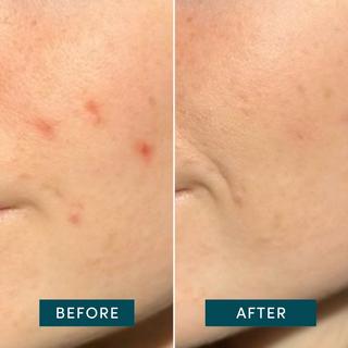 APRICOT Patchs d'acné -  simple against pimple  Patchs Anti-Boutons 