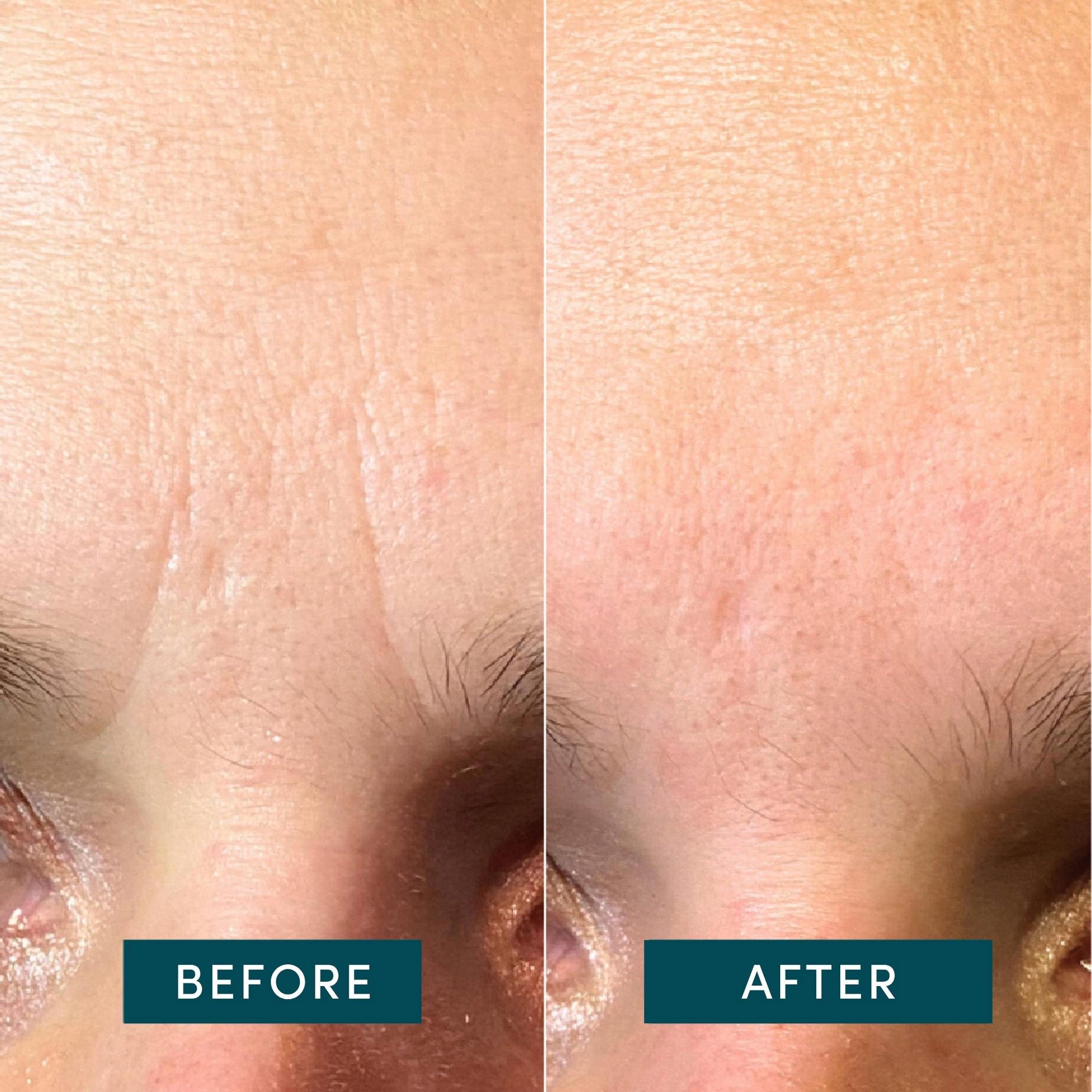 APRICOT  Gesicht Patches mit Hyaluron 