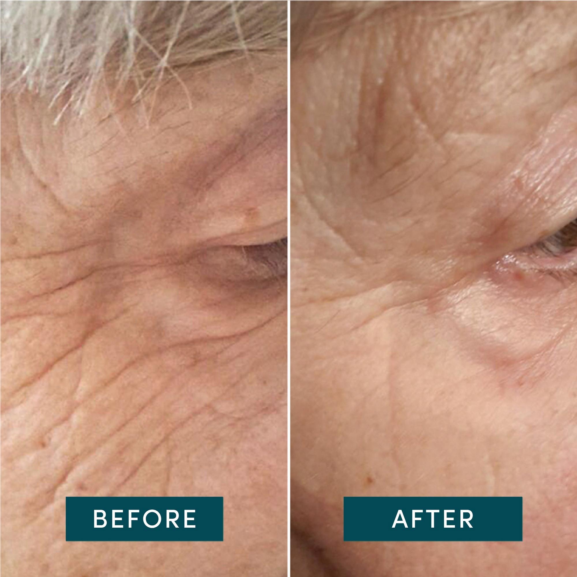 APRICOT  Pads Yeux & Tempes Réutilisables à l’Acide Hyaluronique 