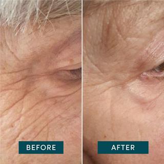 APRICOT  Pad Occhi & Tempie Riutilizzabile all’Acido Ialuronico 