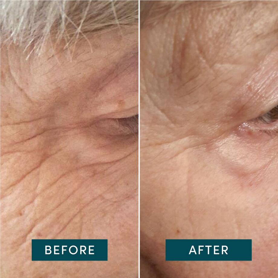 APRICOT  Pad Occhi & Tempie Riutilizzabile all’Acido Ialuronico 