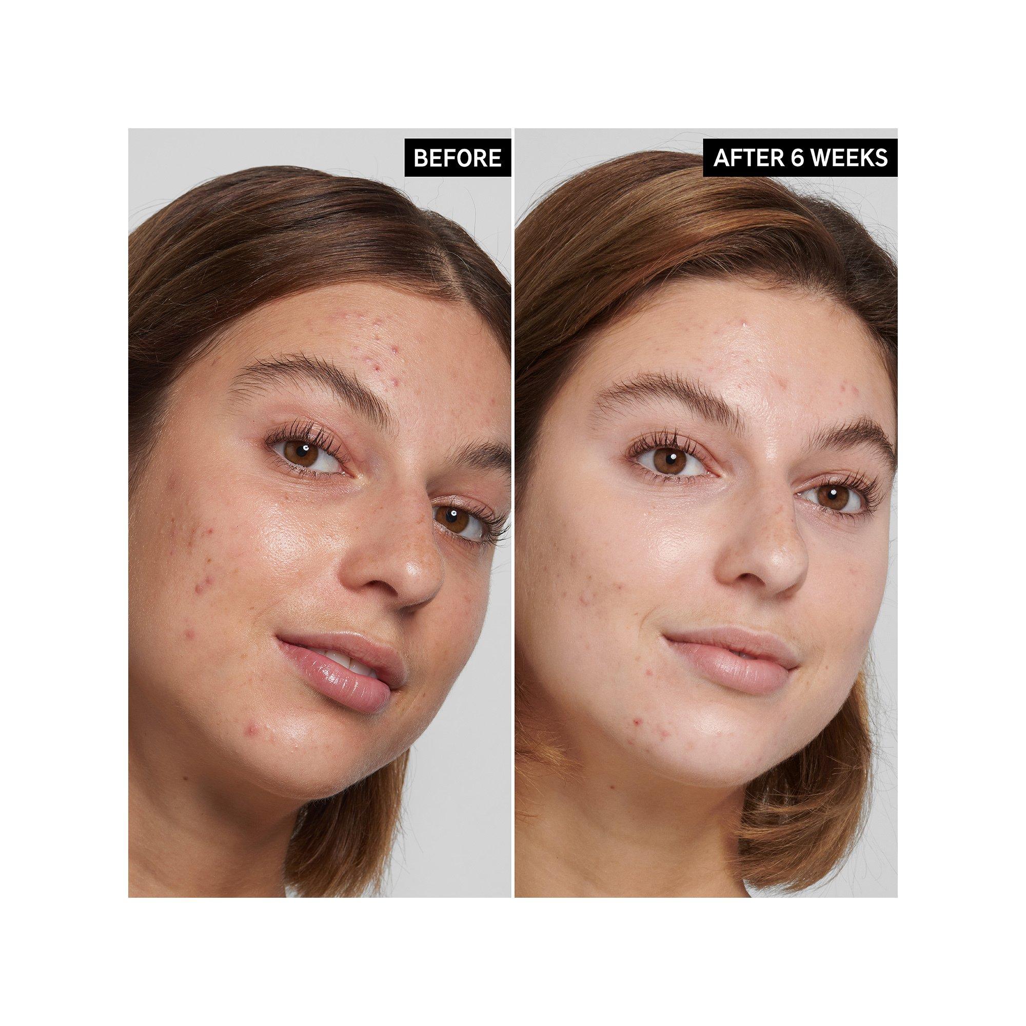 THE INKEY LIST  Nettoyant imperfections + pores à l'acide salicylique 