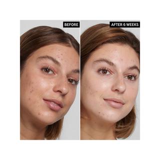 THE INKEY LIST  Pickel- & Porenreiniger mit Salicylsäure 