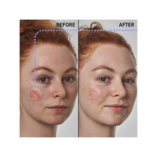 THE INKEY LIST  Soluzione antiarossori con acido azelaico 10% - Siero per il viso 