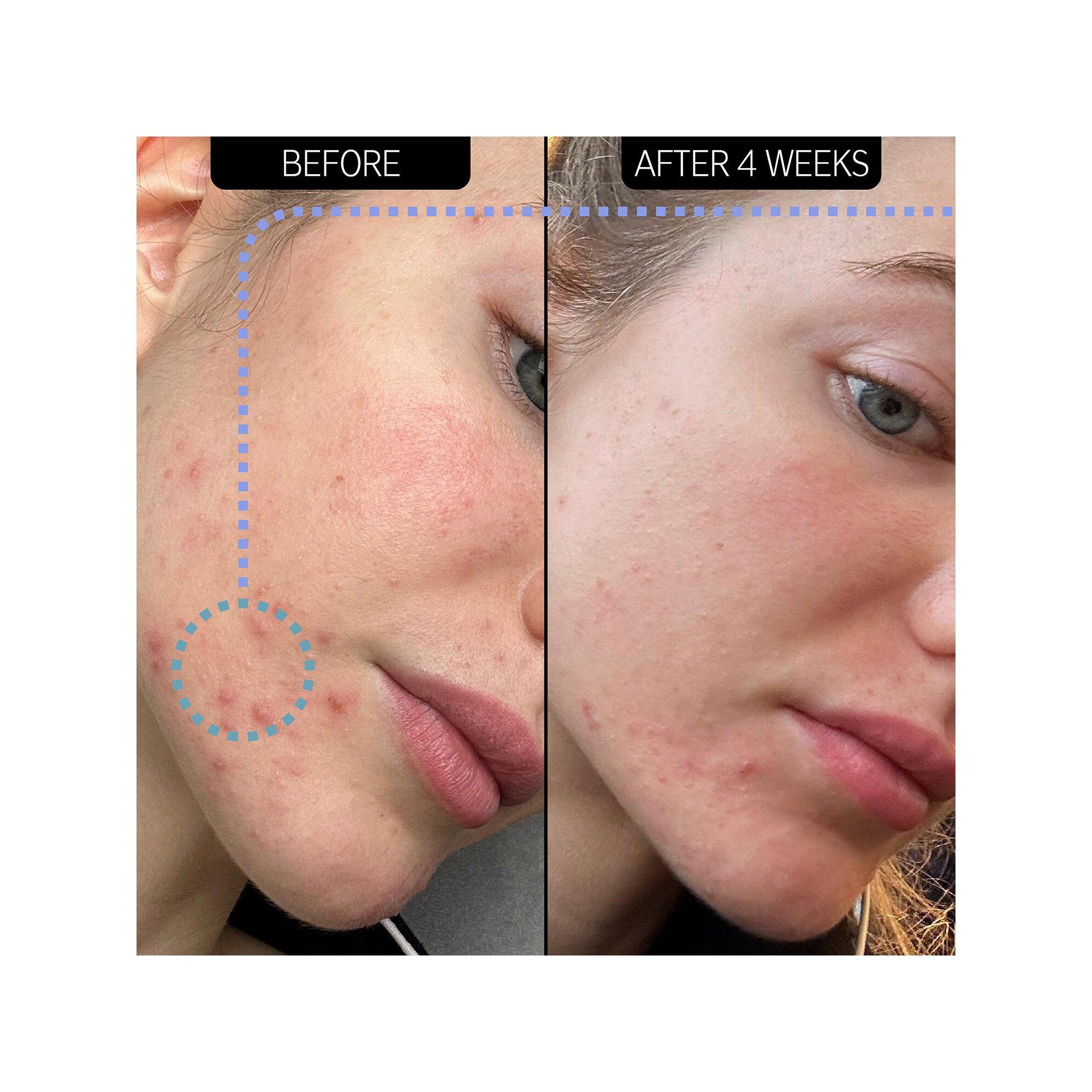 THE INKEY LIST  Blemish Clearing Moisturizer 2% NovoRetin - Crème de Nuit Hydratante 