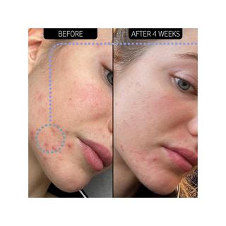 THE INKEY LIST  Feuchtigkeitscreme gegen Hautunreinheiten - 2% NovoRetin™ 