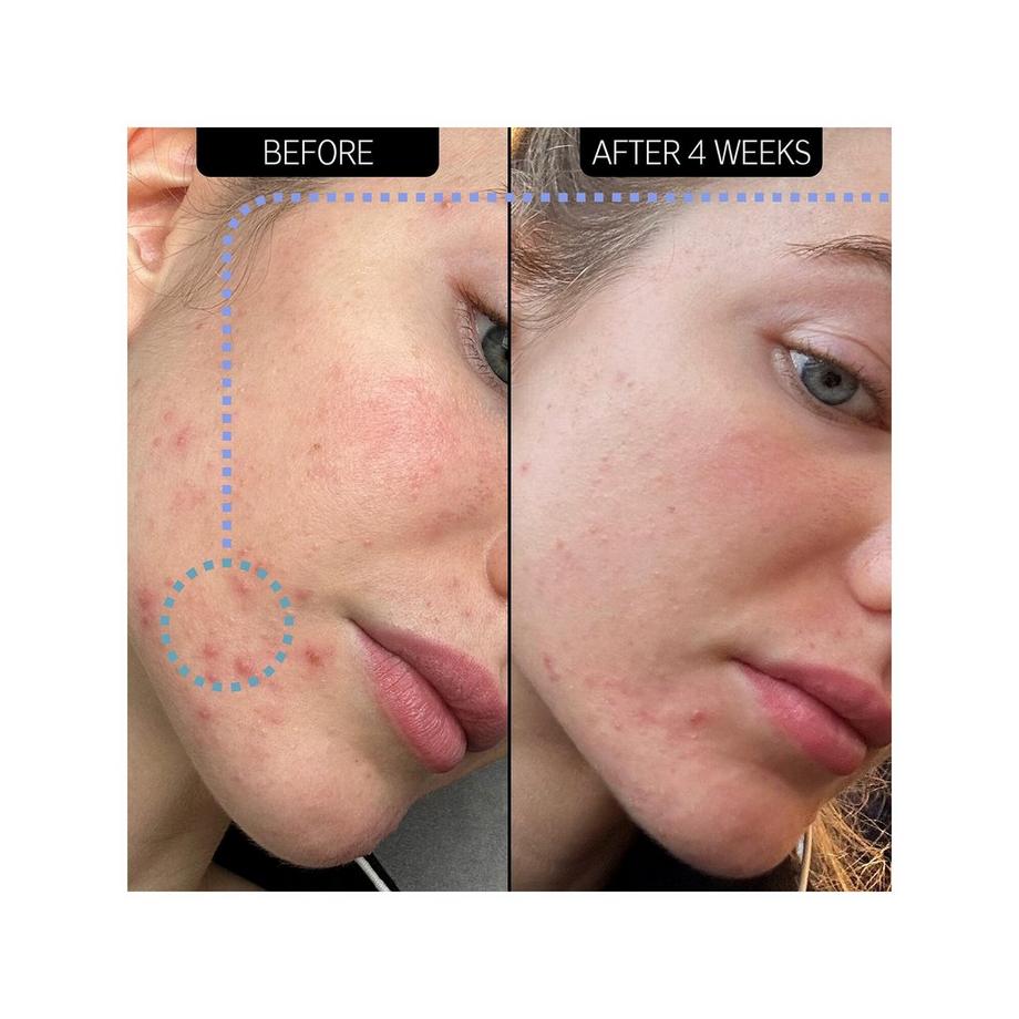 THE INKEY LIST  Feuchtigkeitscreme gegen Hautunreinheiten - 2% NovoRetin™ 