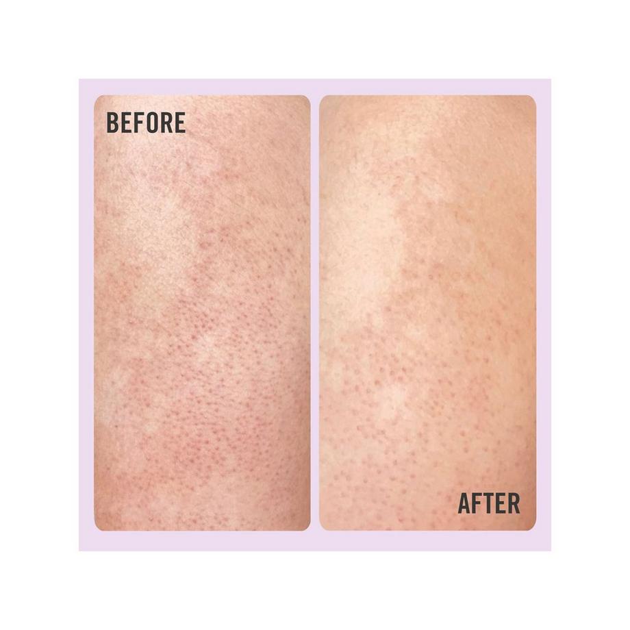 FIRST AID BEAUTY  KP Bump Eraser Body Scrub with 10% AHA - Scrub corpo con AHA 