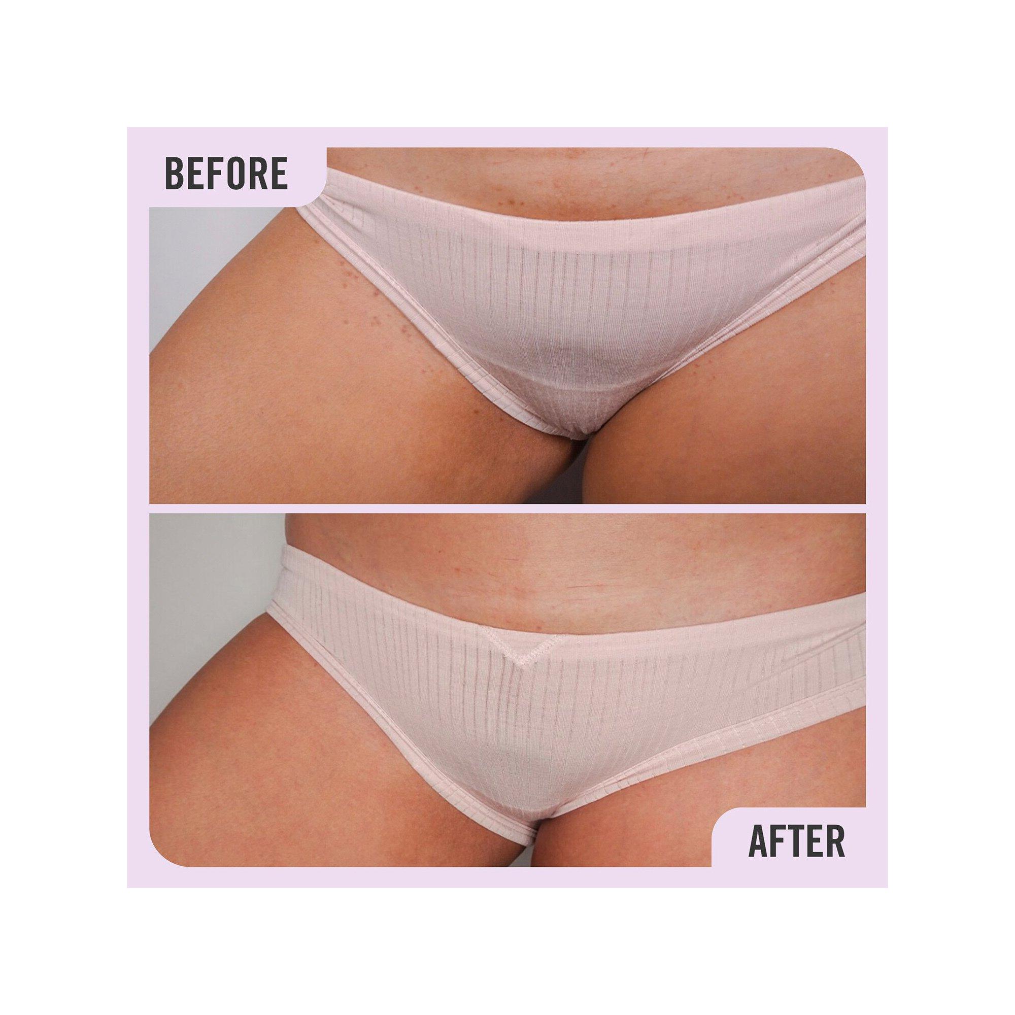 FIRST AID BEAUTY  Ingrown Hair Pads - Pads gegen eingewachsene Haare mit BHA & AHA 