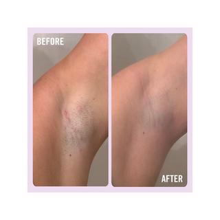 FIRST AID BEAUTY  Ingrown Hair Pads - Pads gegen eingewachsene Haare mit BHA & AHA 