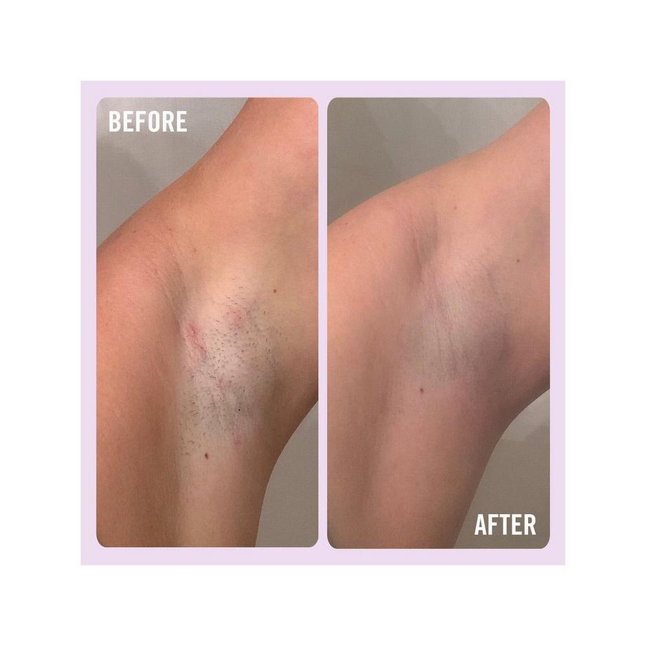 FIRST AID BEAUTY  Ingrown Hair Pads - Disques Pour Poils Incarnés aux BHA & AHA  