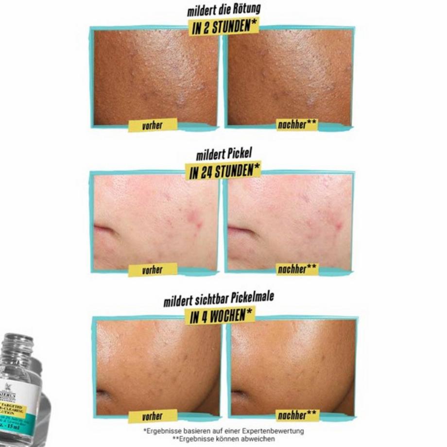 Kiehl's  Truly Targeted Blemish-Clearing Solution 