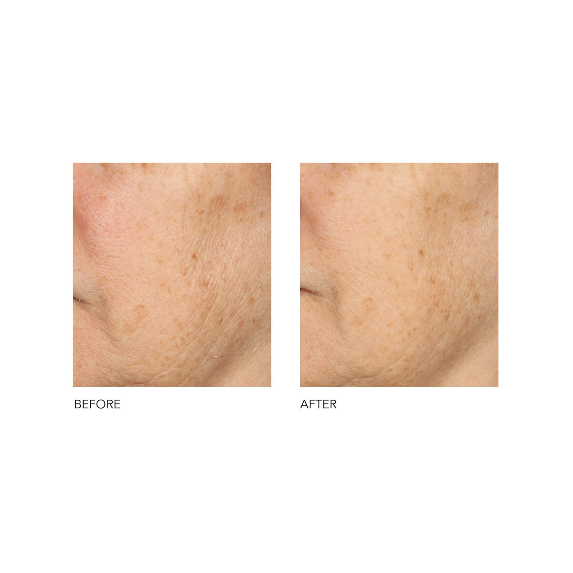 Dr Dennis Gross Alpha Beta®  Peeling Quotidien Formule Universelle 