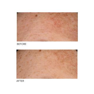 Dr Dennis Gross Alpha Beta®  Peeling Quotidien Formule Universelle 