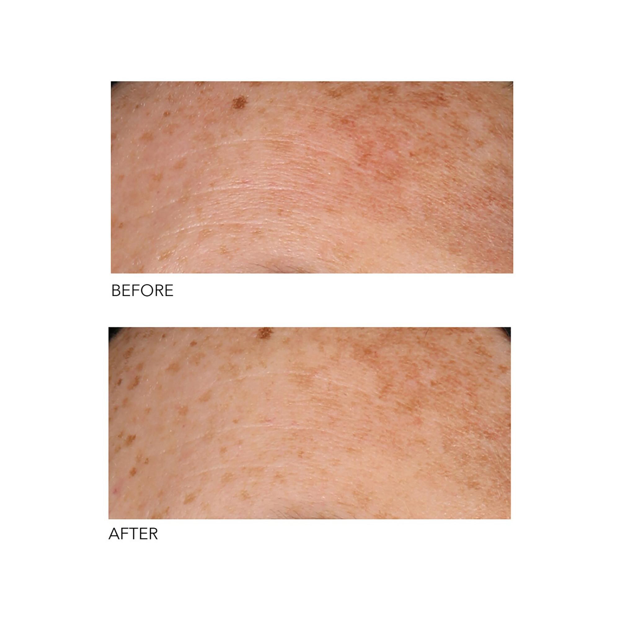 Dr Dennis Gross Alpha Beta®  Peeling Quotidien Formule Universelle 