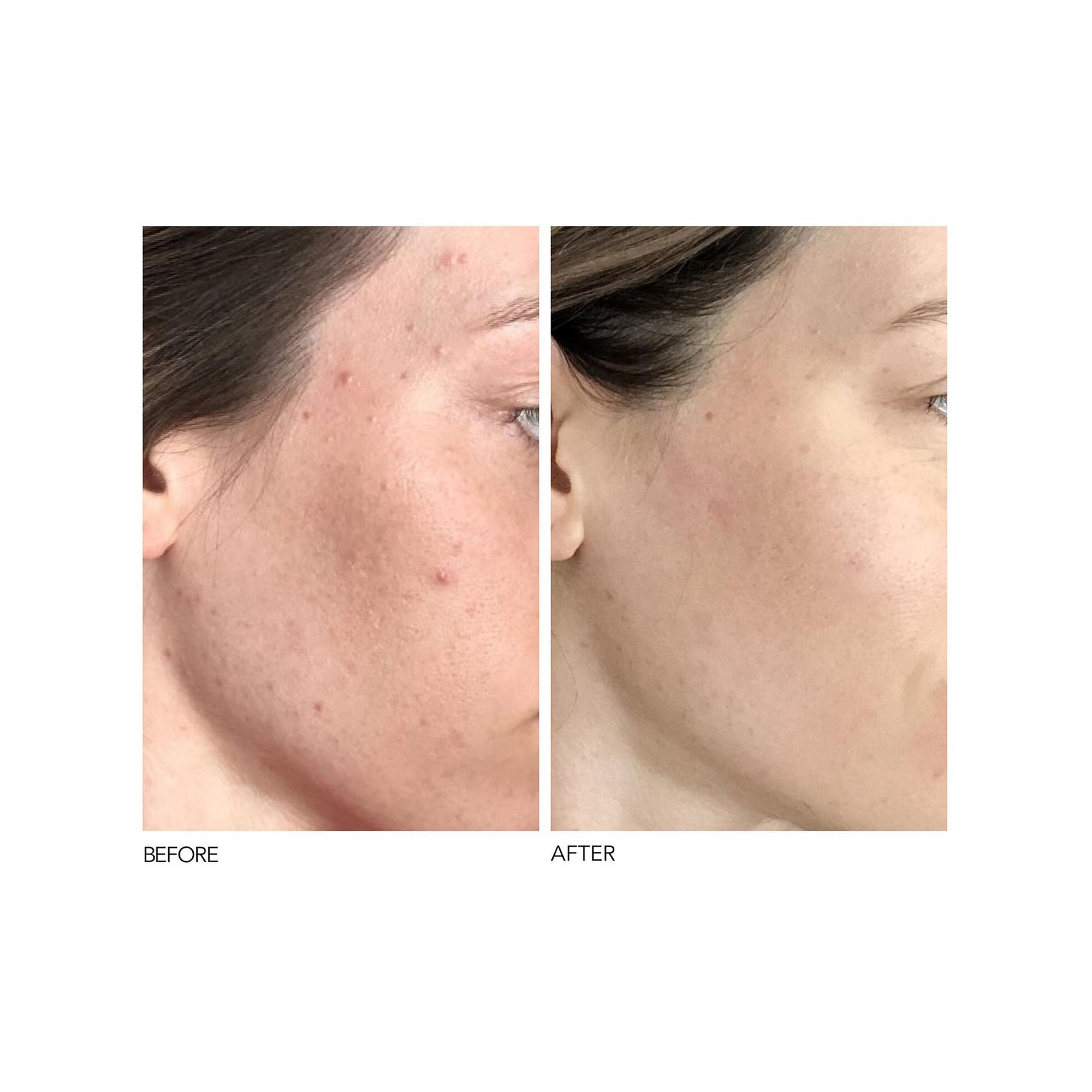Dr Dennis Gross Alpha Beta®  Peeling Quotidien Formule Universelle 