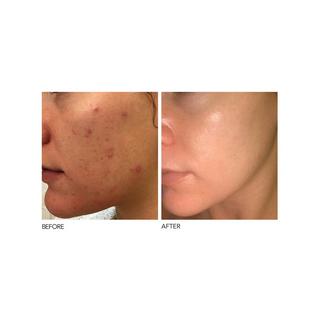 Dr Dennis Gross Alpha Beta®  Peeling Quotidien Formule Intense 