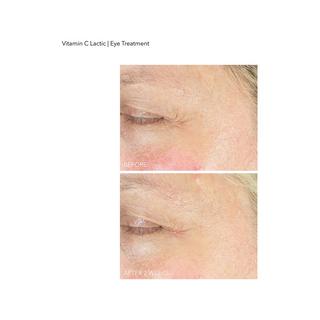 Dr Dennis Gross  Vitamin C Lactic - Soin Contour des Yeux Eclat 