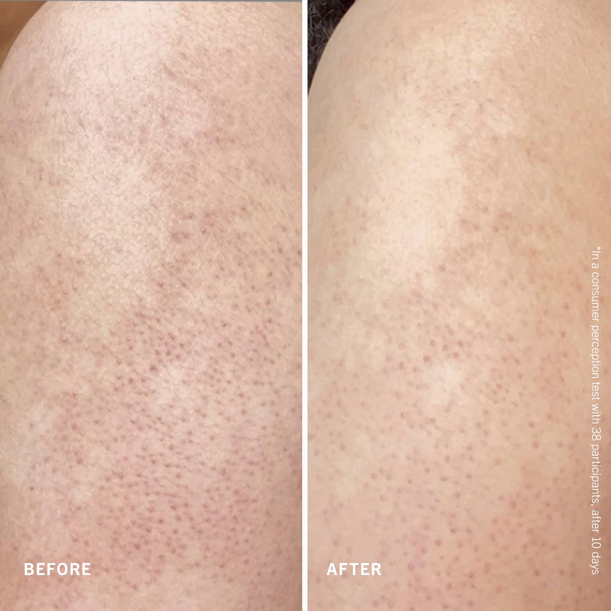 FIRST AID BEAUTY  KP Body Scrub with 10% AHA, Fresh Peach - Körperpeeling mit AHA, Pfirsich 