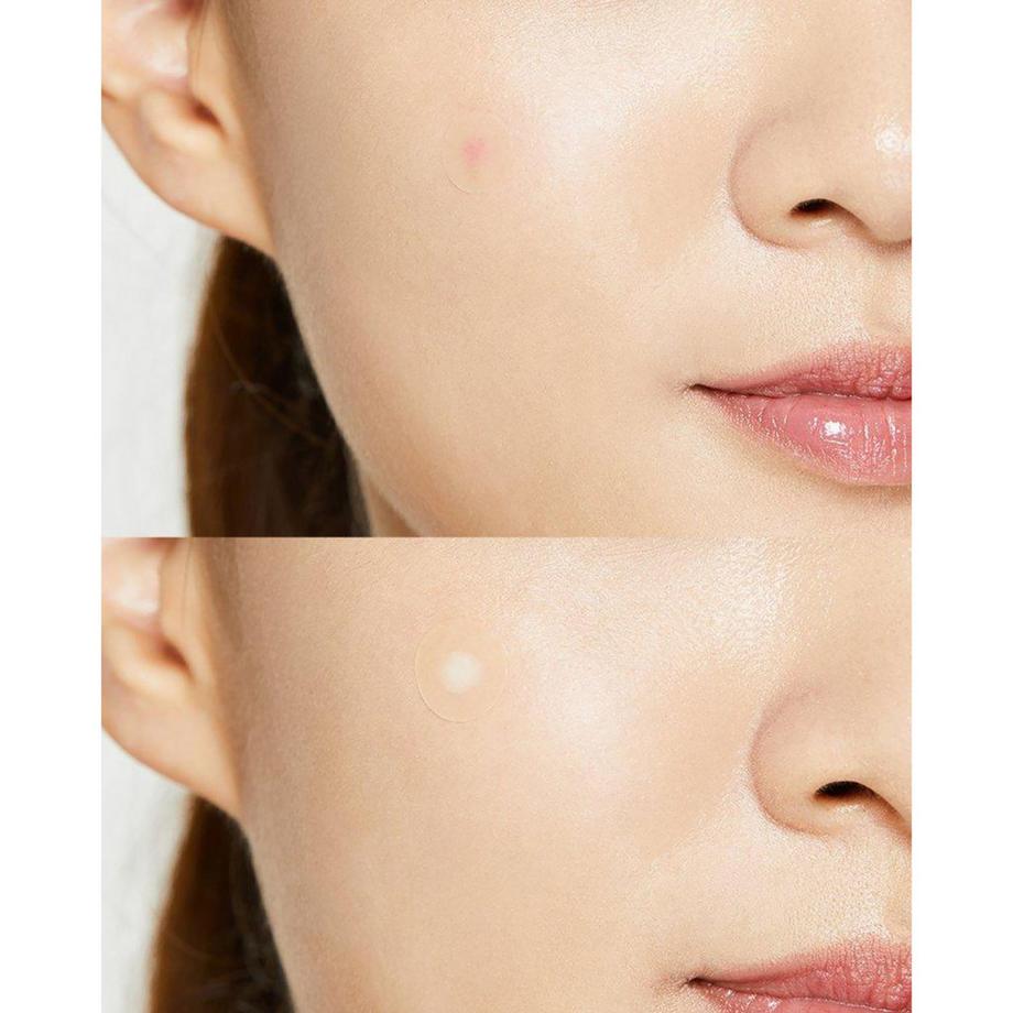 COSRX  Acne Pimple Master Patch 24 Pflaster gegen Pickel 