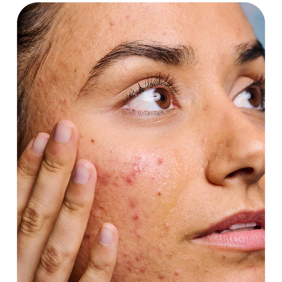 iroha  Acne Prone Face Serum Salycilic Acid 