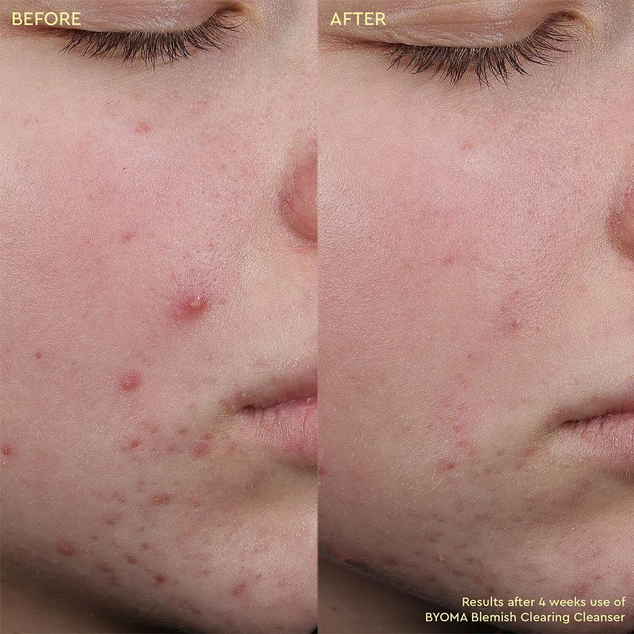 BYOMA  Blemish Clearing Cleanser - Reiniger gegen Unreinheiten 