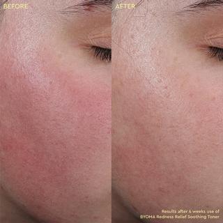 BYOMA  Rednes Relief Soothing Toner - Beruhigendes Gesichtswasser gegen Rötungen 