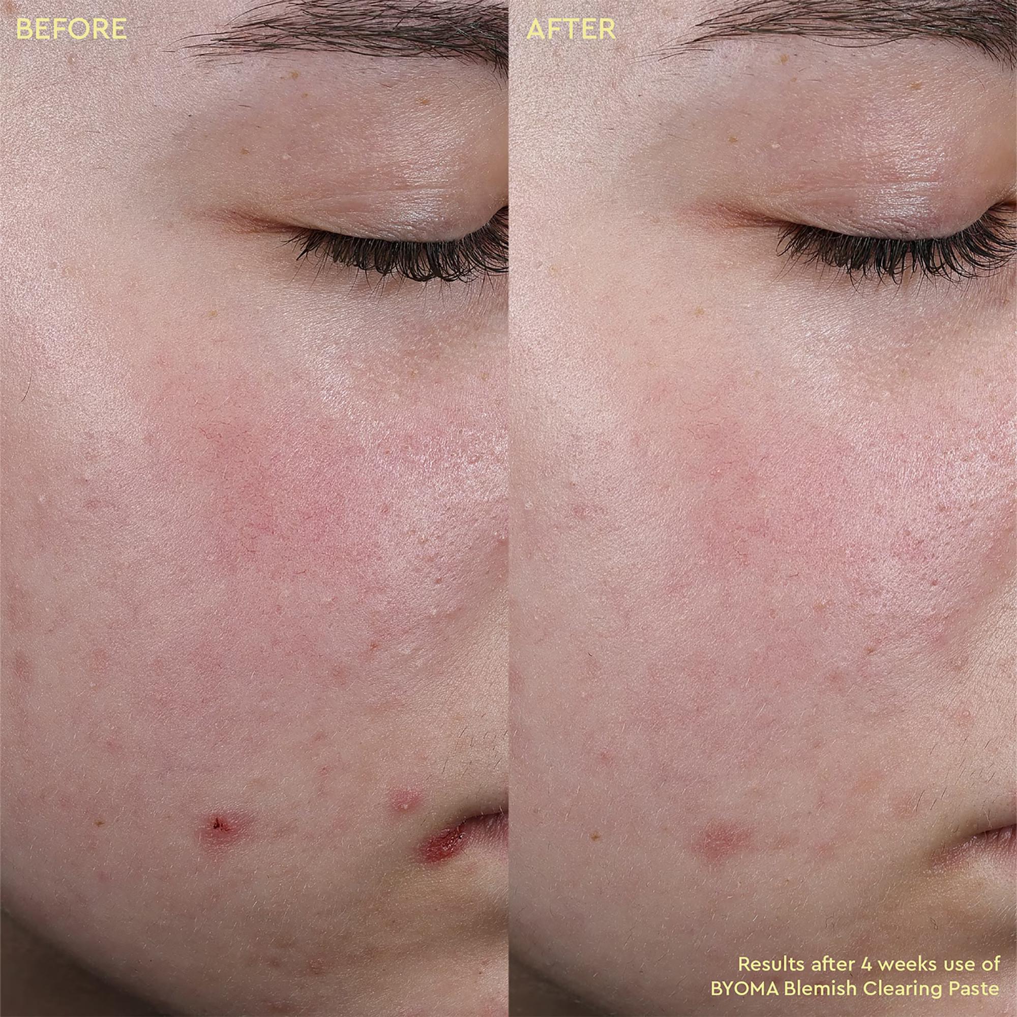 BYOMA  Blemish Clearing Paste - Pasta anti-imperfezioni 