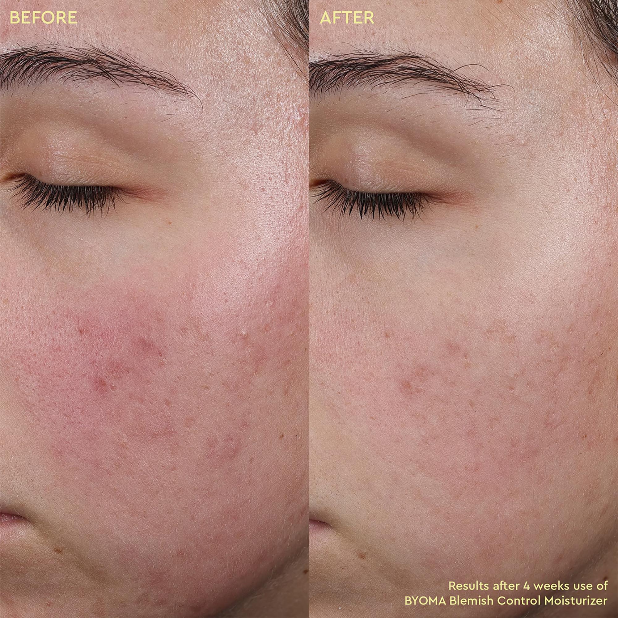 BYOMA  Blemish Control Moisturizer - Crème hydratante anti imperfections 