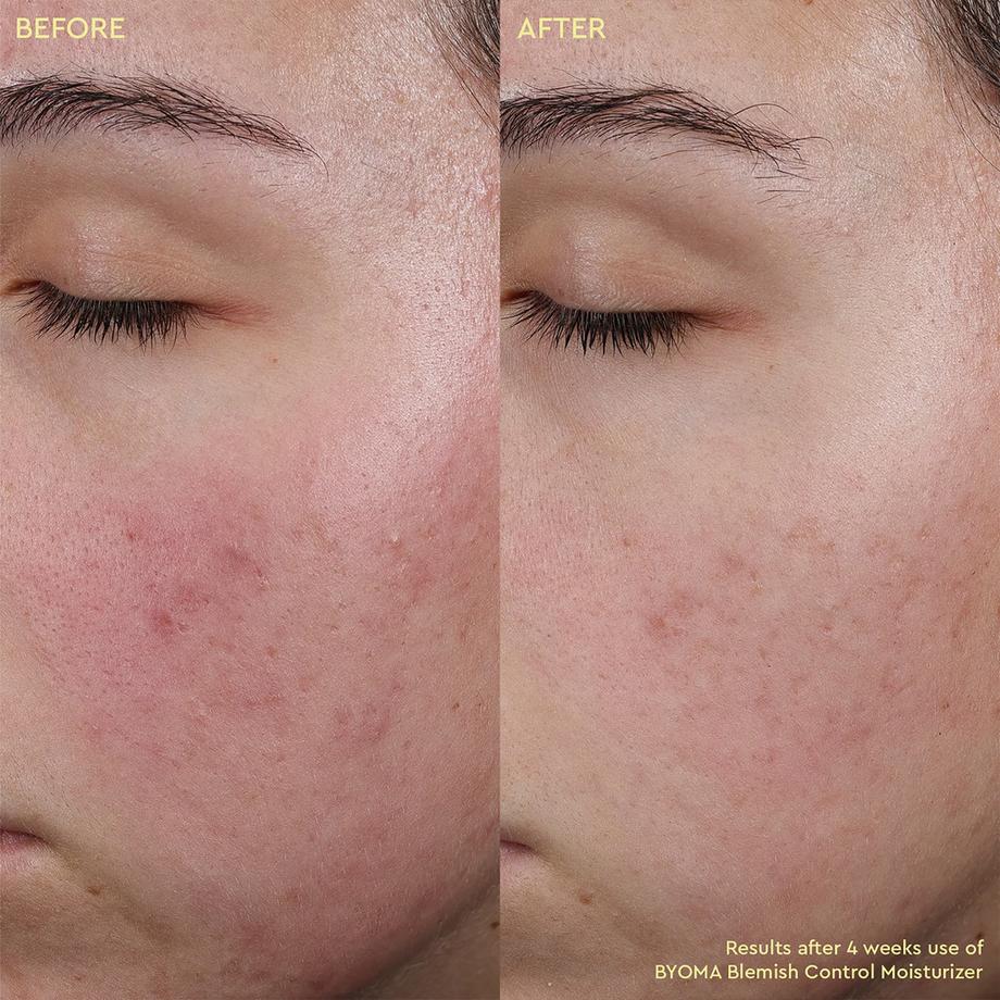 BYOMA  Blemish Control Moisturizer - Feuchtigkeitsspendende Creme gegen Unreinheiten 