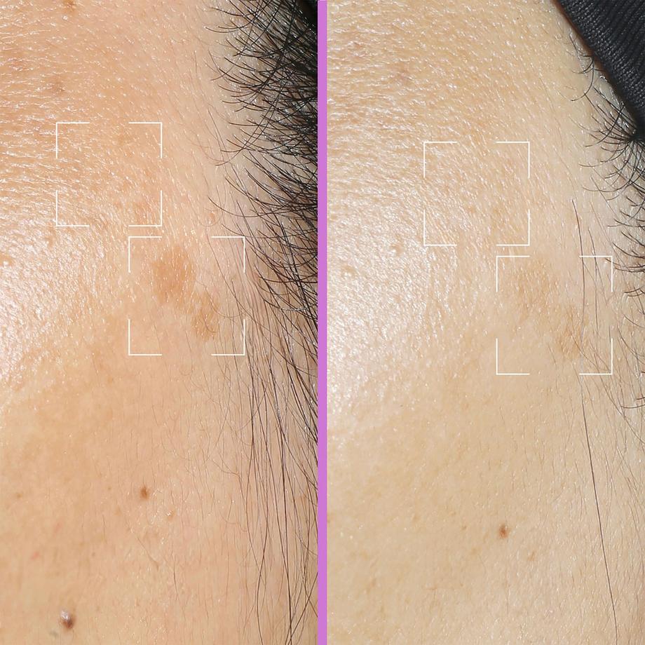 Lightinderm  Spotless Serum - Serum-Kapseln gegen Pigmentflecken mit Niacinamid & Vitamin C 