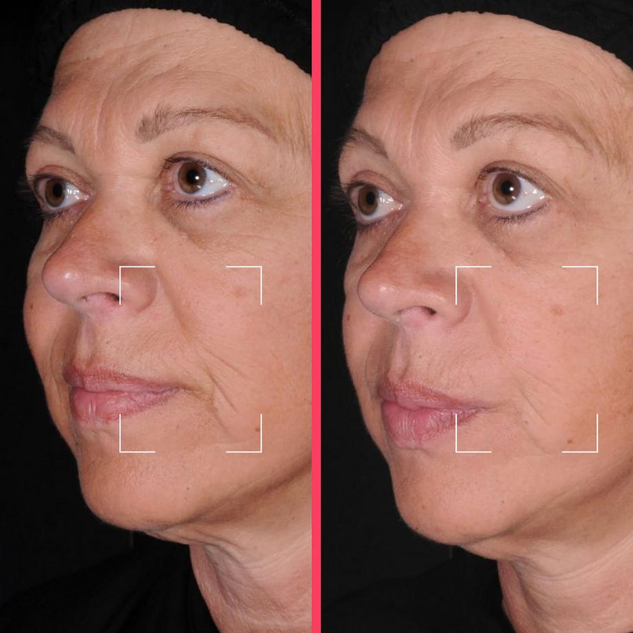 Lightinderm  Capsules Lift – sérum liftant enrichi en Niacinamide, Peptide et HA 