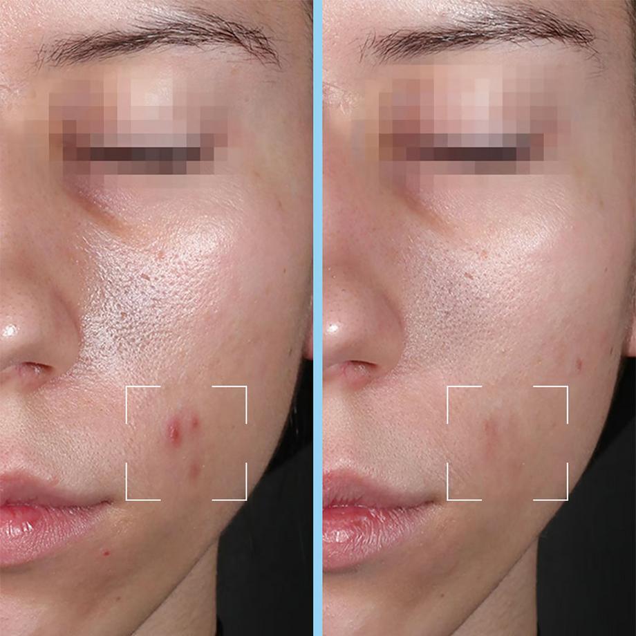 Lightinderm  Capsules Purity - Sérum anti-imperfections enrichi en Acide salycilique et HA 