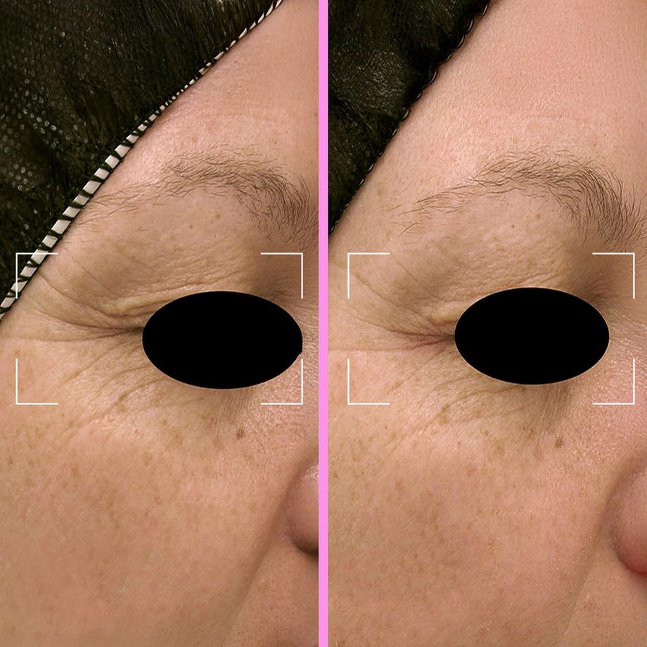 Lightinderm  Repair Serum - Regenerierende Serum-Kapseln mit Niacinamid & Photolyase 