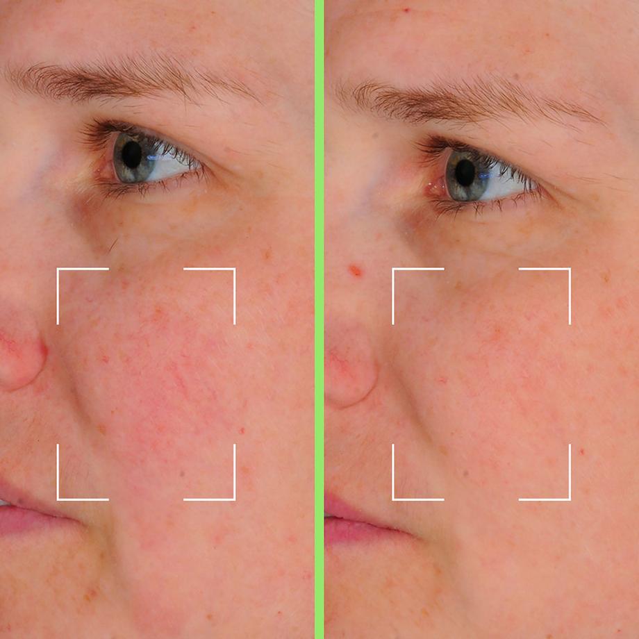 Lightinderm  Redness Refill Serum - perfektionierendes Serum mit Niacinamid, HA und Vit. C 