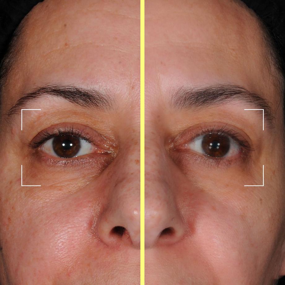 Lightinderm  Capsules Eye – sérum yeux enrichi en Peptides, Caféine, Niacinamide 