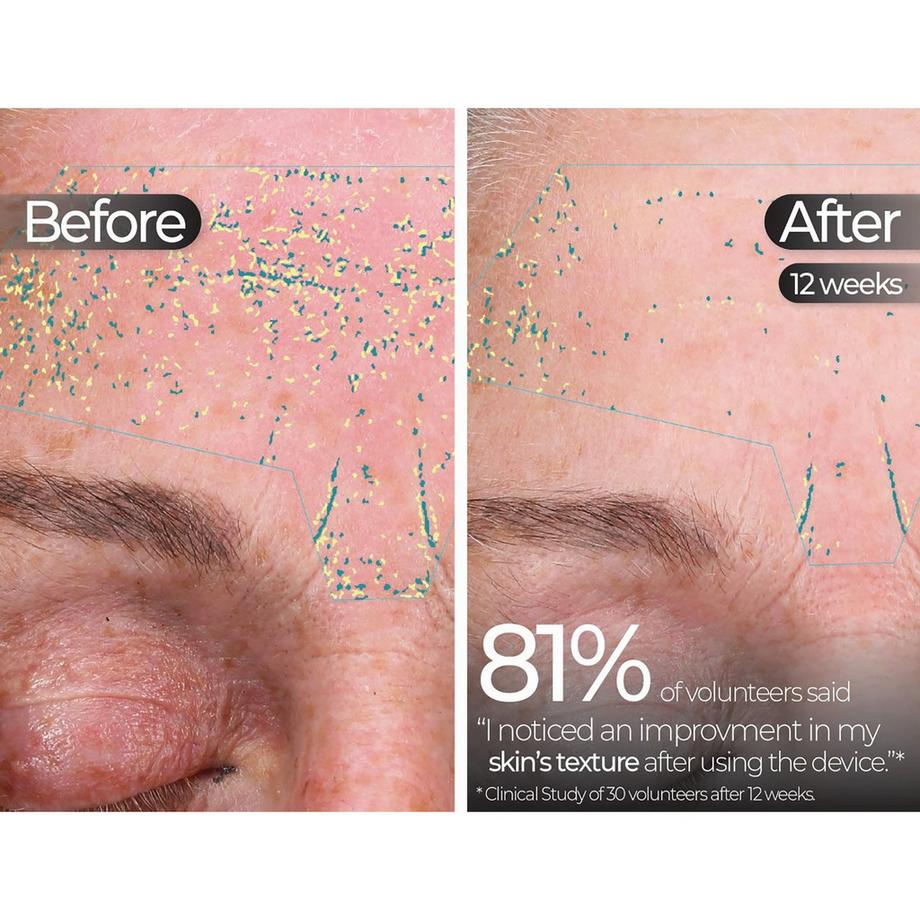 STYLPRO  Masque LED 5-en-1 