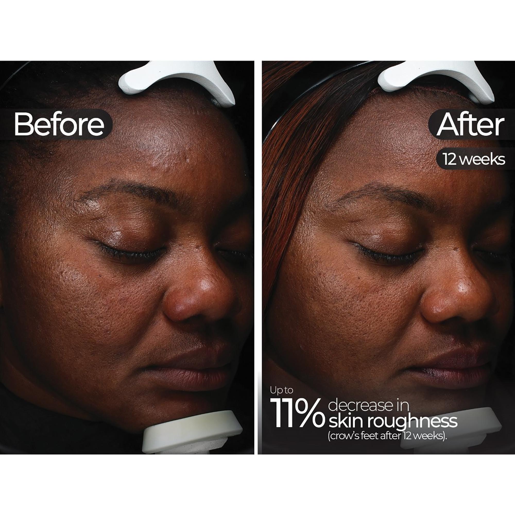 STYLPRO  LED-Maske 5-in-1 