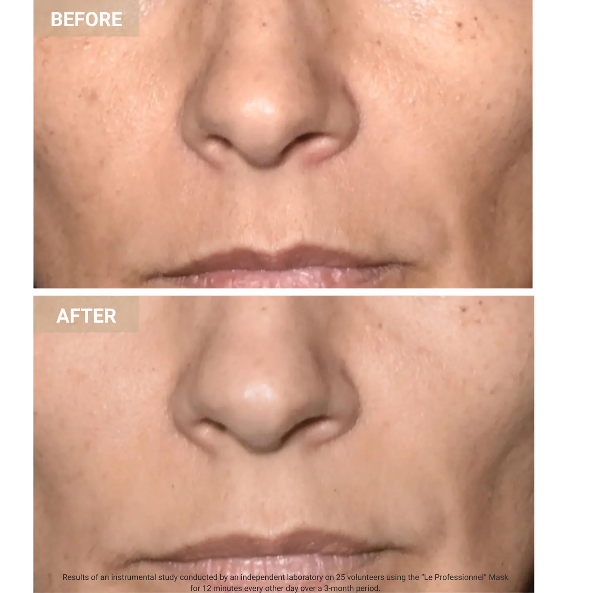 Nooance  Anti-Aging LED Face Mask The Professional - LED-Anti-Aging-Gesichtsmaske 