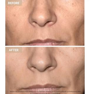 Nooance  Anti-Aging LED Face Mask The Professional - LED-Anti-Aging-Gesichtsmaske 