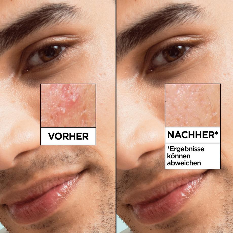 GARNIER  Hautklar Salicylic 7-Day Clinical Siero anti-imperfezioni 